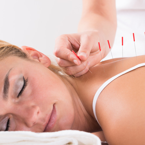 Chiropractic Niles IL Acupuncture