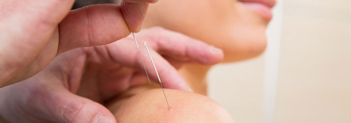 Chiropractic Niles IL Acupuncture